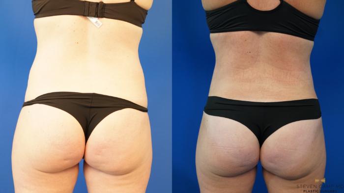 Before & After Liposuction Case 187 View #5 View in Fort Worth & Arlington, Texas