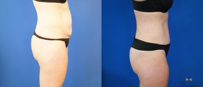 Before & After Tummy Tuck Case 187 View #7 View in Fort Worth & Arlington, Texas
