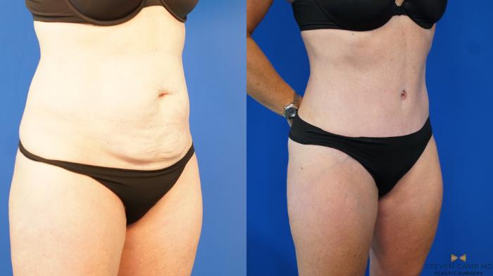 Before & After Tummy Tuck Case 187 View #8 View in Fort Worth & Arlington, Texas