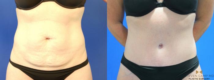 Before & After Tummy Tuck Case 187 View #9 View in Fort Worth & Arlington, Texas