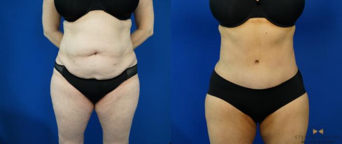 Before & After Tummy Tuck Case 203 View #1 View in Fort Worth, Texas