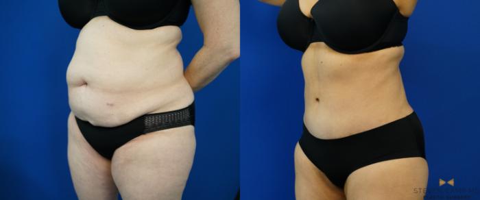 Before & After Tummy Tuck Case 203 View #2 View in Fort Worth, Texas