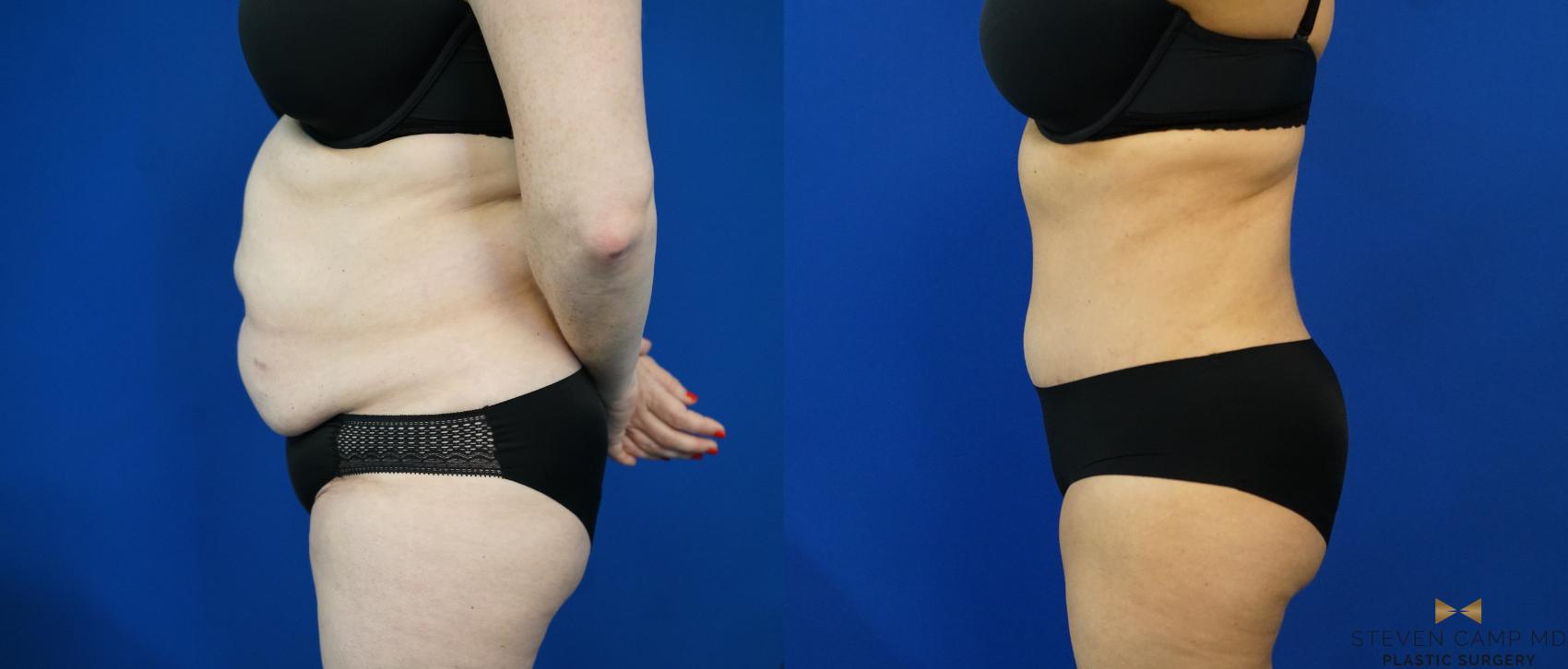Before & After Tummy Tuck Case 203 View #3 View in Fort Worth & Arlington, Texas
