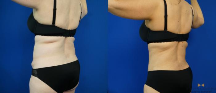 Before & After Tummy Tuck Case 203 View #4 View in Fort Worth, Texas