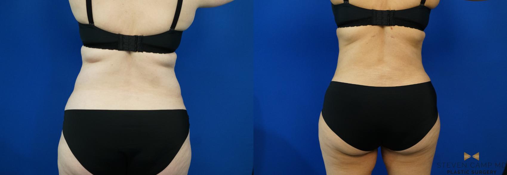 Before & After Tummy Tuck Case 203 View #5 View in Fort Worth & Arlington, Texas