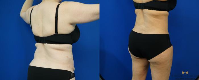 Before & After Tummy Tuck Case 203 View #6 View in Fort Worth & Arlington, Texas