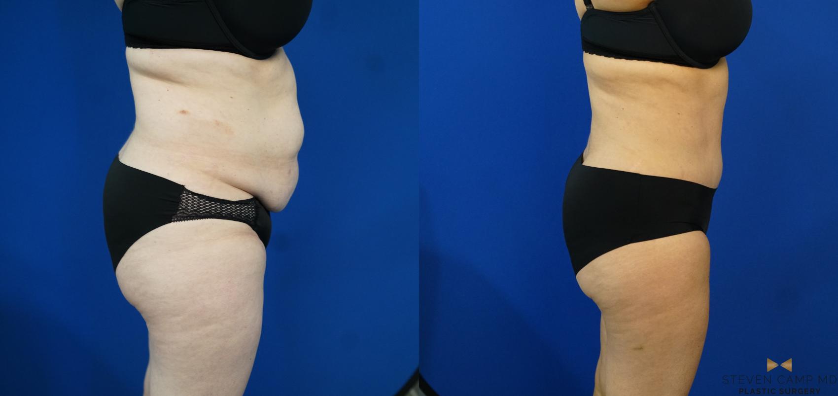 Before & After Tummy Tuck Case 203 View #7 View in Fort Worth & Arlington, Texas