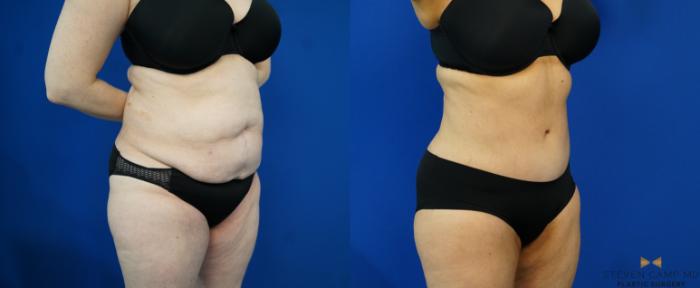 Before & After Tummy Tuck Case 203 View #8 View in Fort Worth & Arlington, Texas