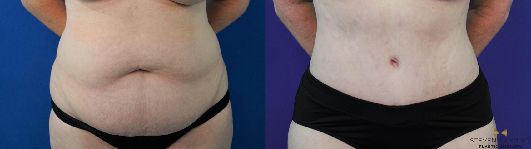 Before & After Liposuction Case 305 View #1 View in Fort Worth & Arlington, Texas