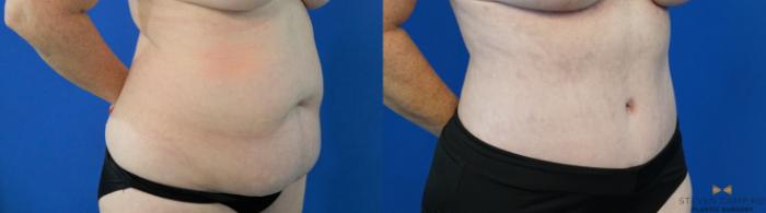 Before & After Tummy Tuck Case 305 View #2 View in Fort Worth & Arlington, Texas