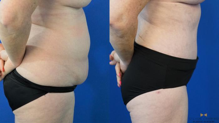 Before & After Tummy Tuck Case 305 View #3 View in Fort Worth & Arlington, Texas