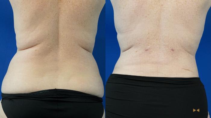 Before & After Liposuction Case 305 View #5 View in Fort Worth & Arlington, Texas