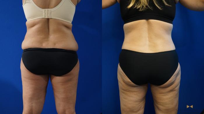 Before & After Liposuction Case 321 Back View in Fort Worth & Arlington, Texas