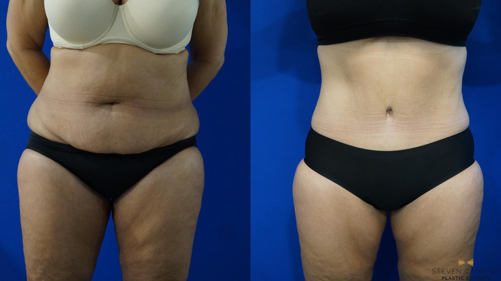 Before & After Tummy Tuck Case 321 Front View in Fort Worth, Texas