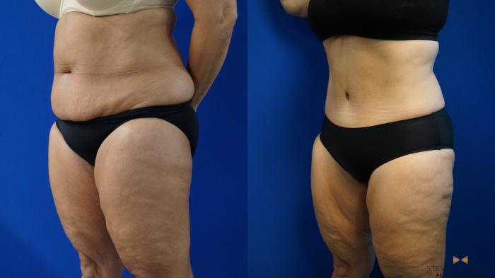 Before & After Liposuction Case 321 Left Oblique View in Fort Worth & Arlington, Texas