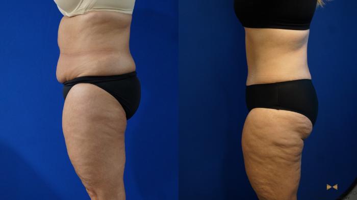 Before & After Liposuction Case 321 Left Side View in Fort Worth & Arlington, Texas