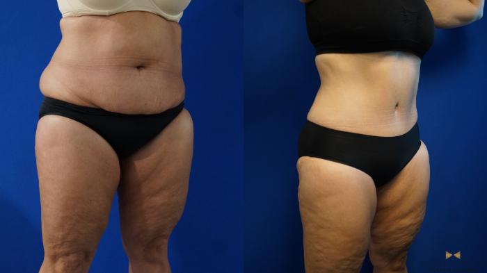 Before & After Tummy Tuck Case 321 Right Oblique View in Fort Worth, Texas
