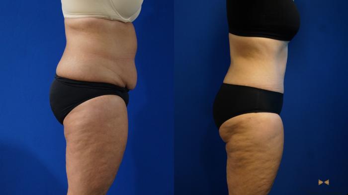 Before & After Liposuction Case 321 Right Side View in Fort Worth & Arlington, Texas