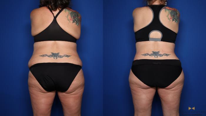 Before & After Liposuction Case 351 Back View in Fort Worth & Arlington, Texas
