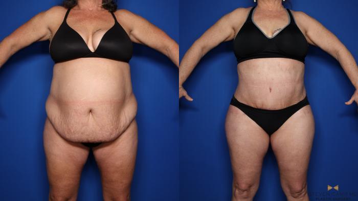 Before & After Tummy Tuck Case 351 Front View in Fort Worth & Arlington, Texas