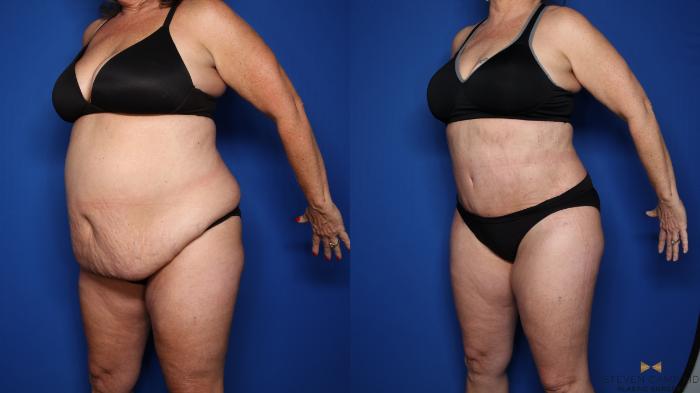 Before & After Liposuction Case 351 Left Oblique View in Fort Worth & Arlington, Texas