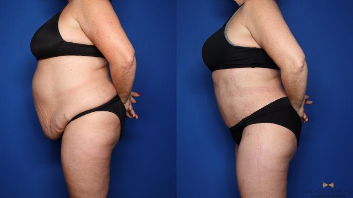 Before & After Tummy Tuck Case 351 Left Side View in Fort Worth & Arlington, Texas