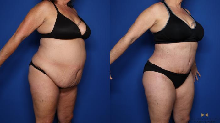 Before & After Tummy Tuck Case 351 Right Oblique View in Fort Worth, Texas