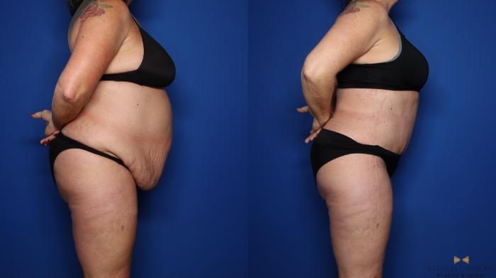 Before & After Tummy Tuck Case 351 Right Side View in Fort Worth, Texas