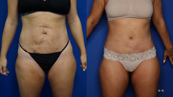 Before & After Tummy Tuck Case 379 Front View in Fort Worth & Arlington, Texas