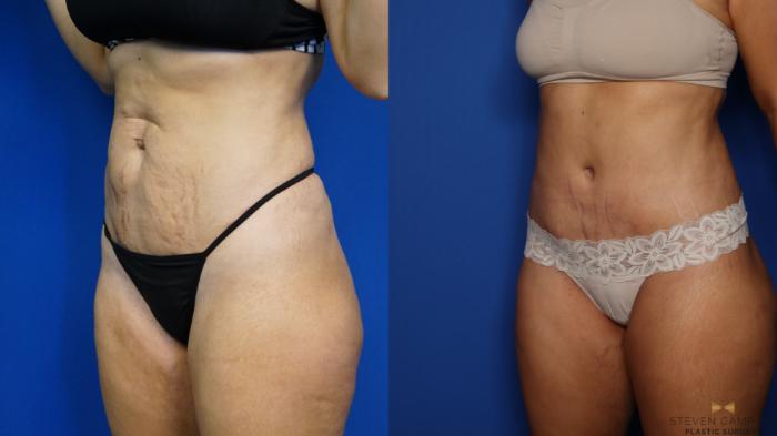 Before & After Brazilian Butt Lift Case 379 Left Oblique View in Fort Worth & Arlington, Texas
