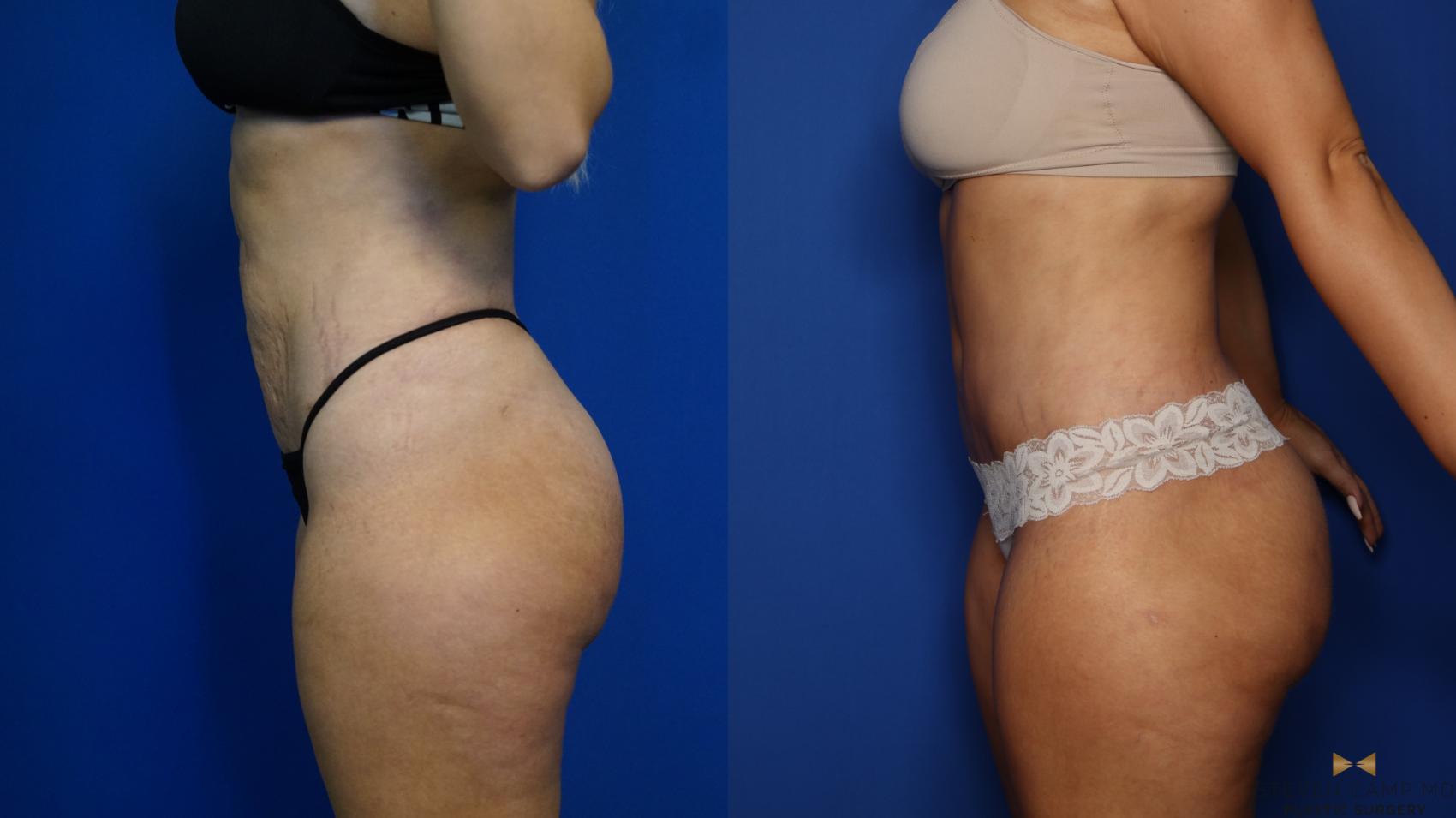 Before & After Tummy Tuck Case 379 Left Side View in Fort Worth & Arlington, Texas