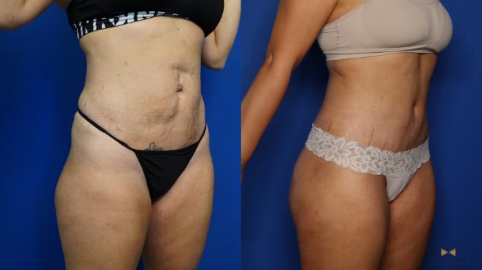 Before & After Liposuction Case 379 Right Oblique View in Fort Worth & Arlington, Texas