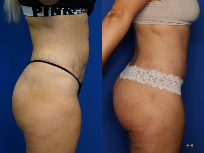 Before & After Brazilian Butt Lift Case 379 Right Side View in Fort Worth & Arlington, Texas
