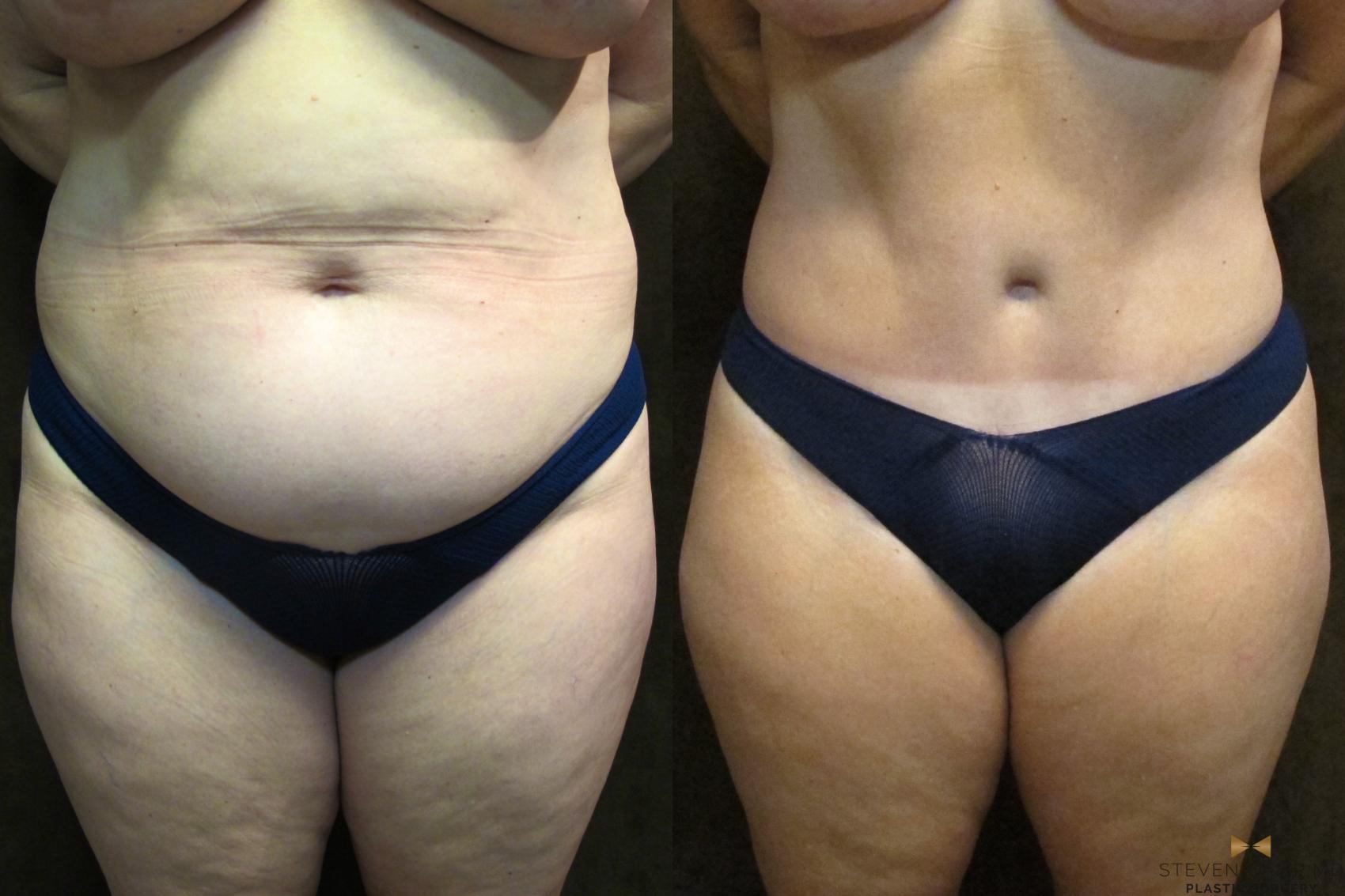 Before & After Tummy Tuck Case 38 View #1 View in Fort Worth, Texas