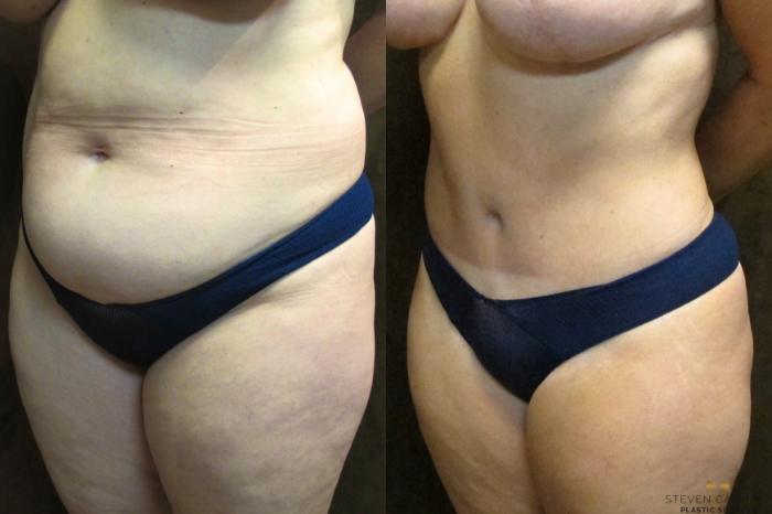 Before & After Tummy Tuck Case 38 View #2 View in Fort Worth & Arlington, Texas