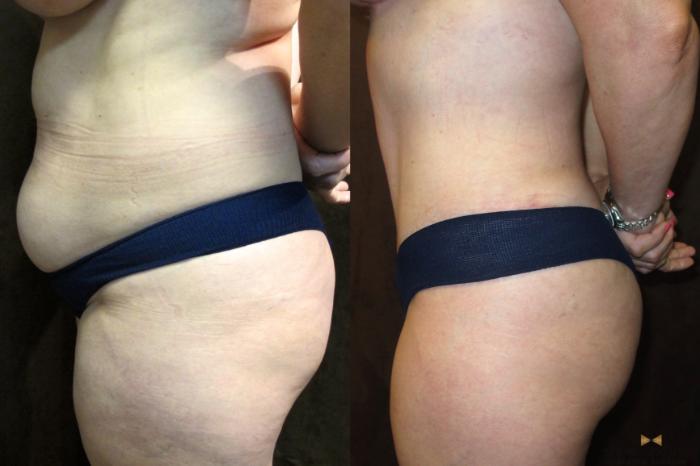 Before & After Tummy Tuck Case 38 View #3 View in Fort Worth, Texas