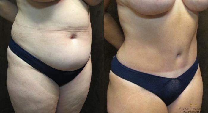 Before & After Tummy Tuck Case 38 View #4 View in Fort Worth, Texas