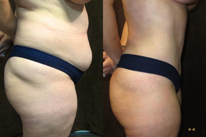Before & After Tummy Tuck Case 38 View #5 View in Fort Worth & Arlington, Texas