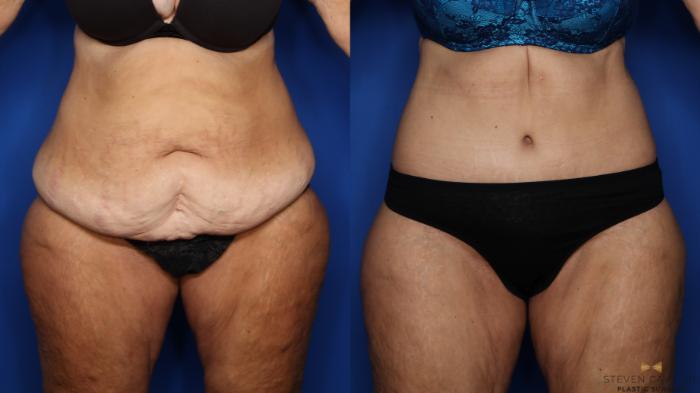 Before & After Tummy Tuck Case 380 Front View in Fort Worth & Arlington, Texas