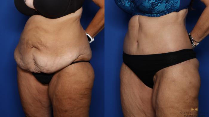 Before & After Tummy Tuck Case 380 Left Oblique View in Fort Worth & Arlington, Texas