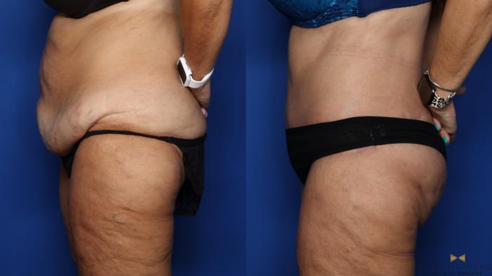 Before & After Tummy Tuck Case 380 Left Side View in Fort Worth & Arlington, Texas