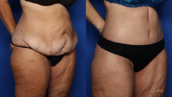 Before & After Tummy Tuck Case 380 Right Oblique View in Fort Worth & Arlington, Texas