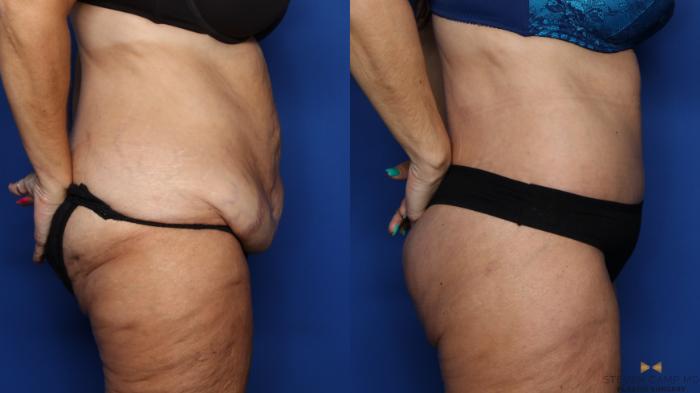 Before & After Tummy Tuck Case 380 Right Side View in Fort Worth & Arlington, Texas