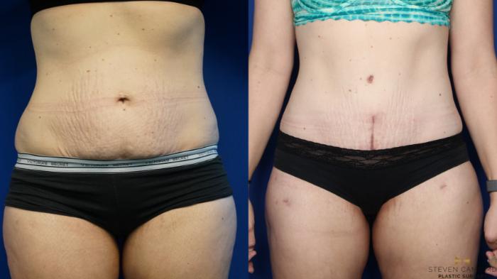Before & After Tummy Tuck Case 381 Front View in Fort Worth & Arlington, Texas