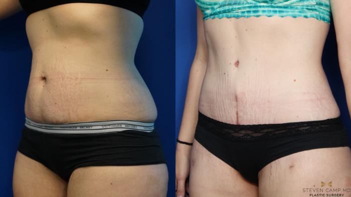 Before & After Tummy Tuck Case 381 Left Oblique View in Fort Worth, Texas