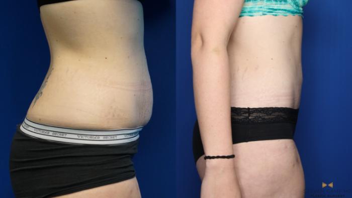 Before & After Tummy Tuck Case 381 Right Side View in Fort Worth, Texas