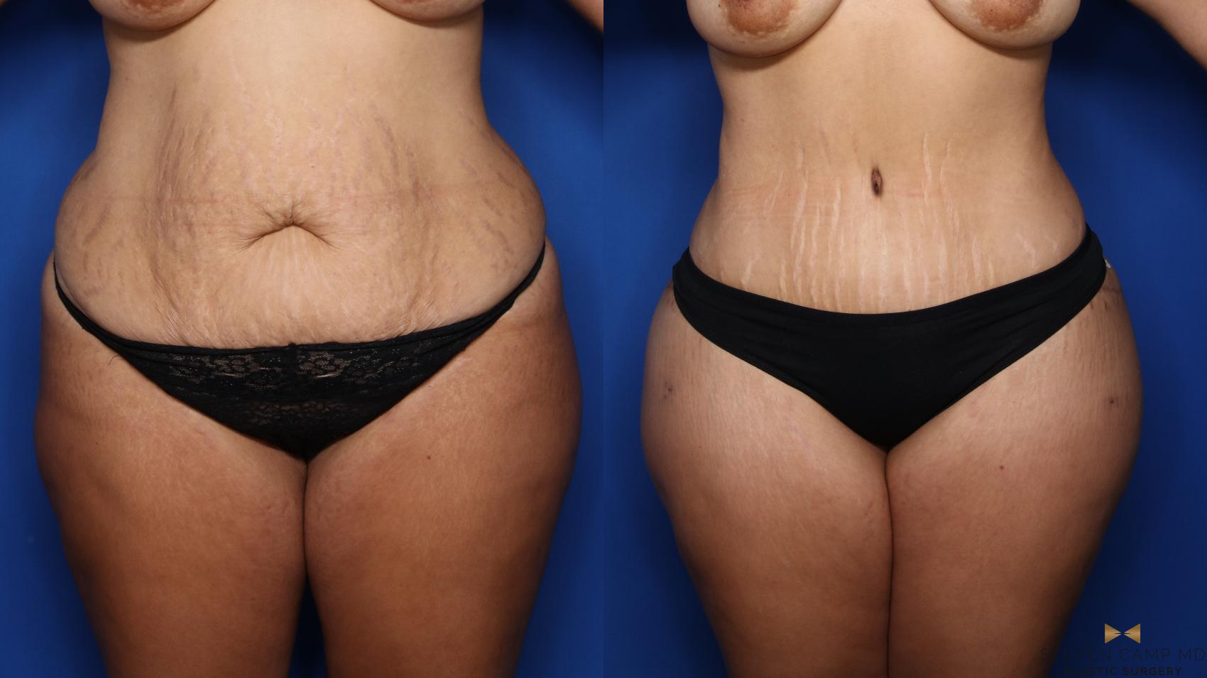 Before & After Tummy Tuck Case 382 Front View in Fort Worth & Arlington, Texas