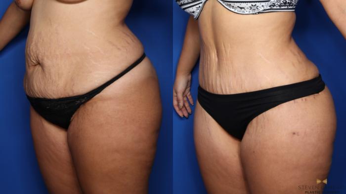 Before & After Liposuction Case 382 Left Oblique View in Fort Worth & Arlington, Texas