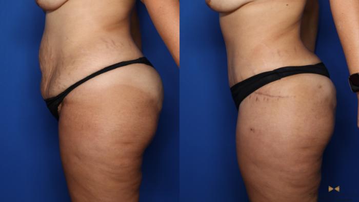 Before & After Tummy Tuck Case 382 Left Side View in Fort Worth & Arlington, Texas