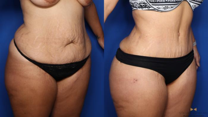 Before & After Tummy Tuck Case 382 Right Oblique View in Fort Worth & Arlington, Texas